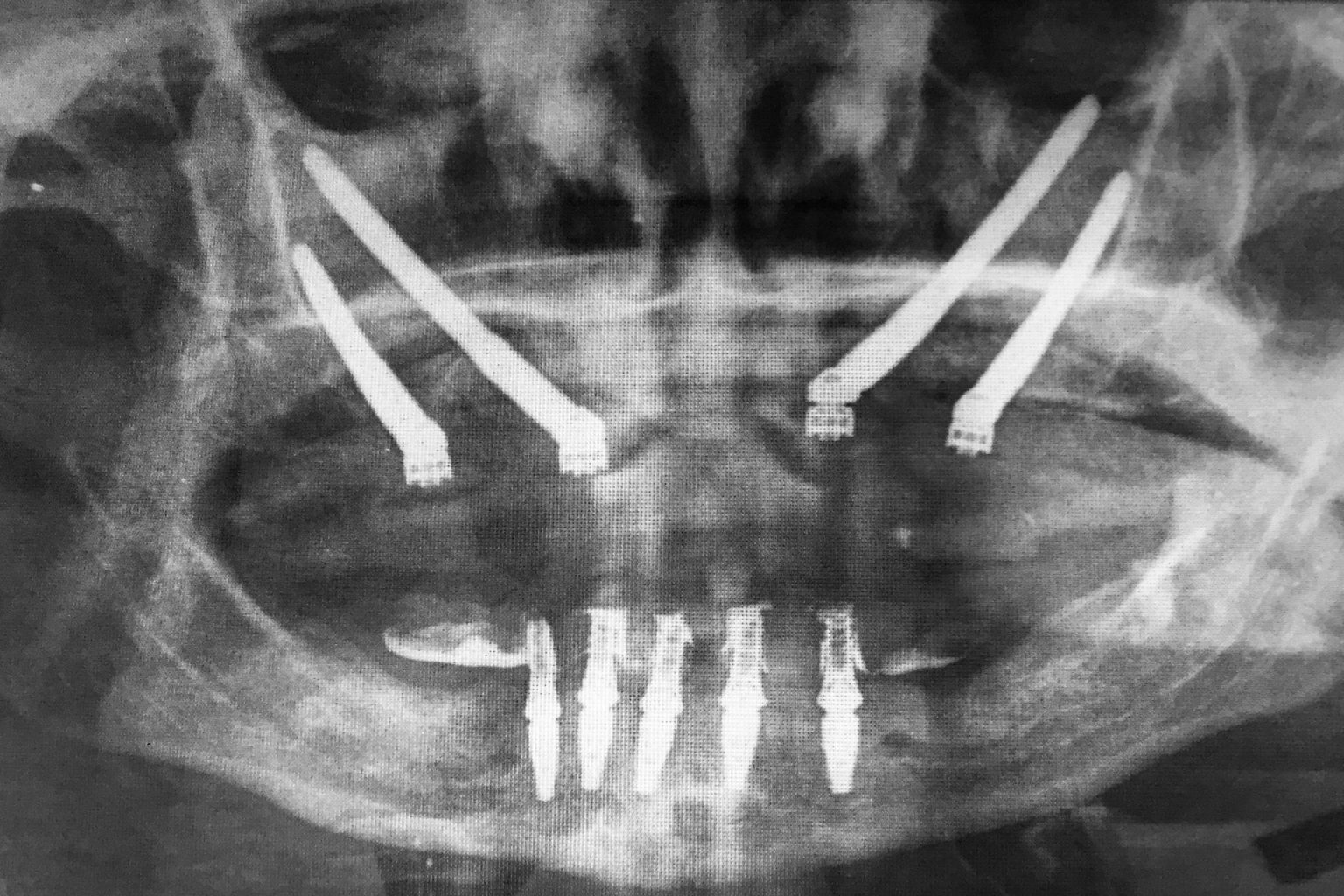 implantes-cigomaticos-ICOA