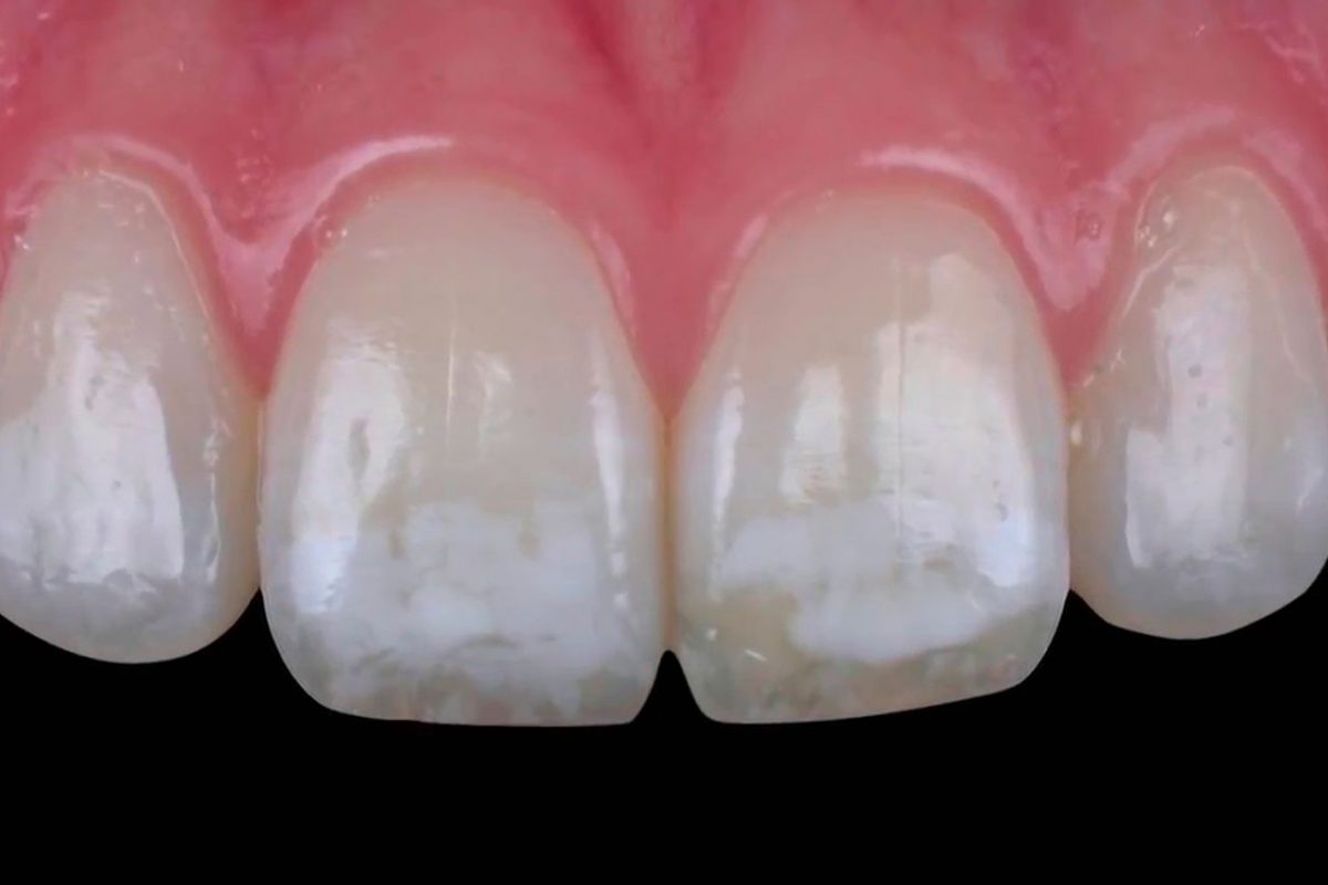 fluoriosis-manchas-blancas-dientes-icoa