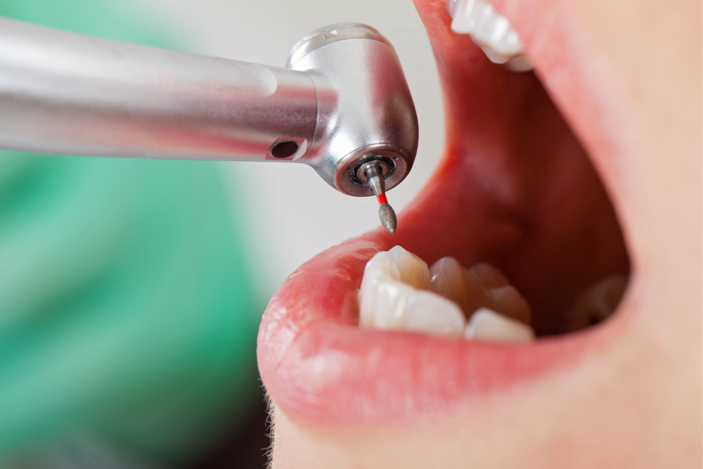 qué es una endodoncia y en qué consiste